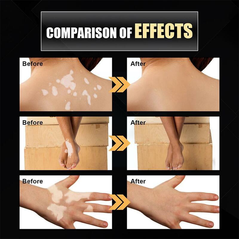 Hidratante Vitiligo Net Spray, Reparação facial desvanece-se, Manchas do corpo, Mancha, Vitiligo, Branco, Alívio, Alívio, R2U4, 30ml