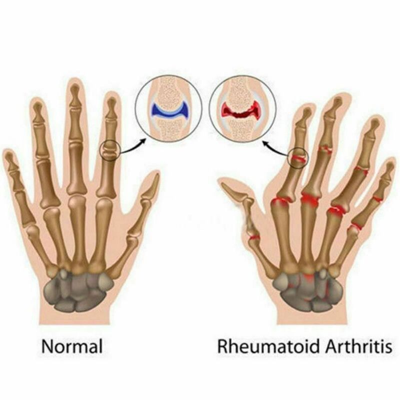 ถุงมือรักษาอาการปวดข้อรูมาตอยด์ถุงมือรักษาแบบยืดหยุ่นไม่มีนิ้วป้องกันโรคข้ออักเสบ Relief อาการปวดมือ