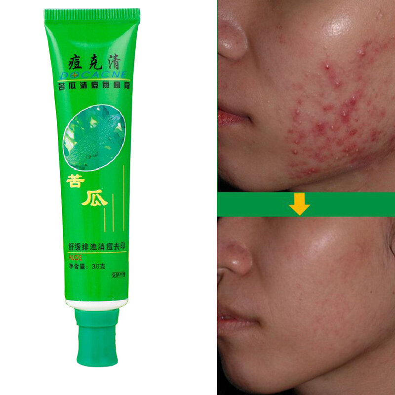 30g rimozione del viso crema per l'acne macchie di brufoli trattamento della cicatrice riparazione della cura della pelle per adulti