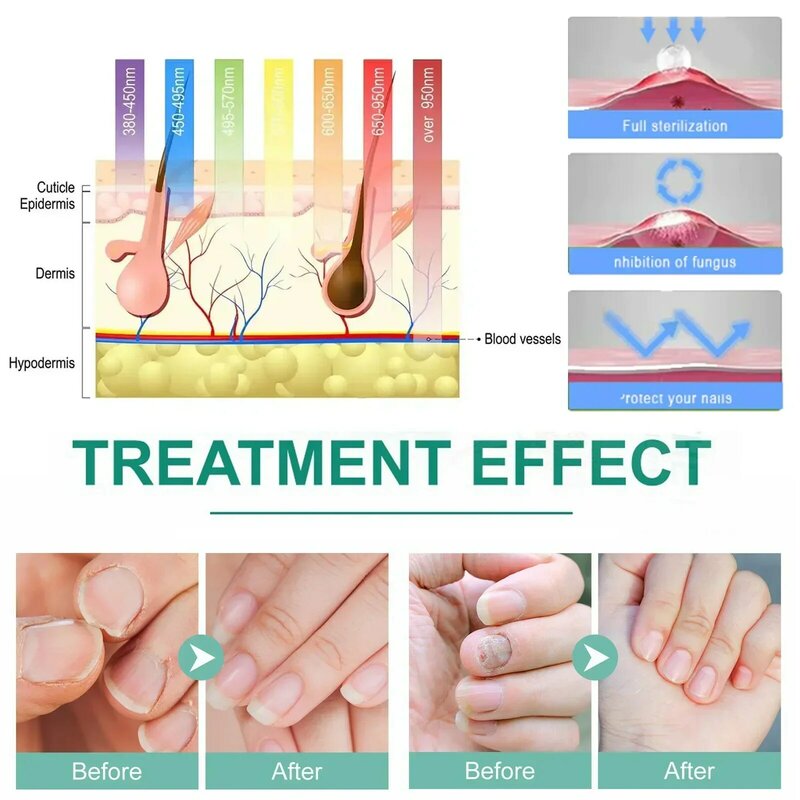 2024 Fungal Nail Laser Device Repair Fast Nails Fungus Onychomycosis Repair Toenail Fingernail Removes Nail Fungus Foot Care