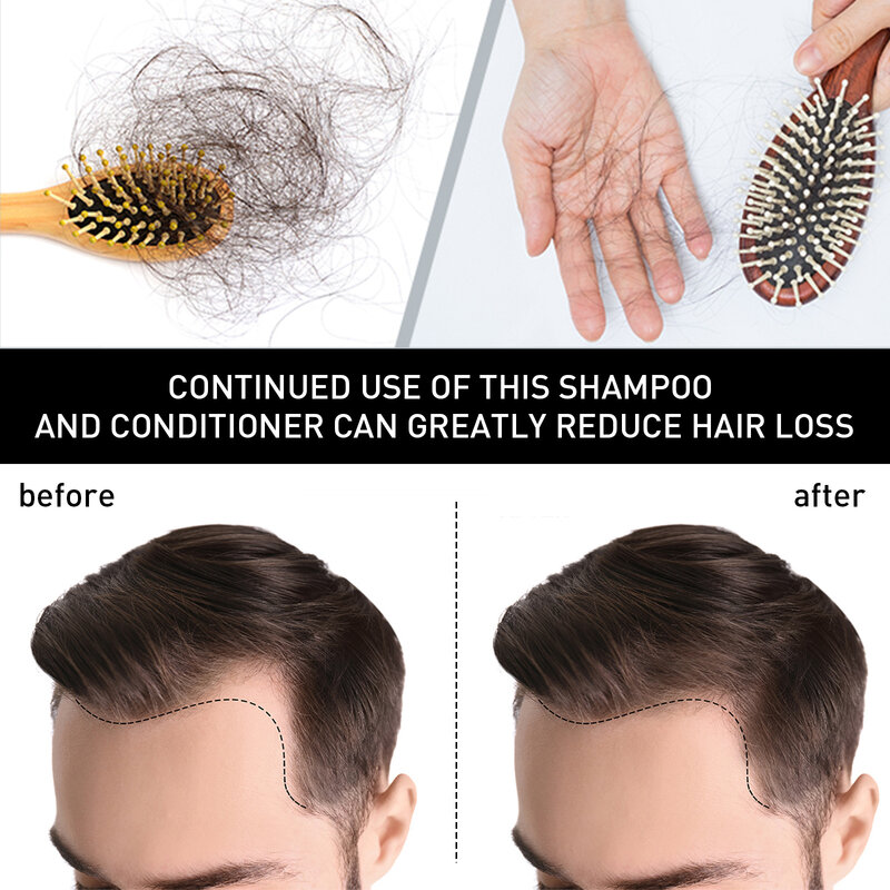 Huile essentielle de traitement contre la perte de cheveux, prévient la calvitie, réparation crépue et endommagée, collecte dense, nourrit le cuir chevelu, huile de repousse des cheveux