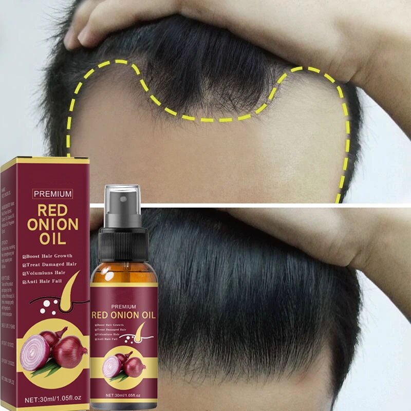 Serum penumbuh rambut, semprot kuat memperbaiki akar penumbuh rambut Anti rambut rontok perawatan esensi untuk pria wanita perawatan rambut
