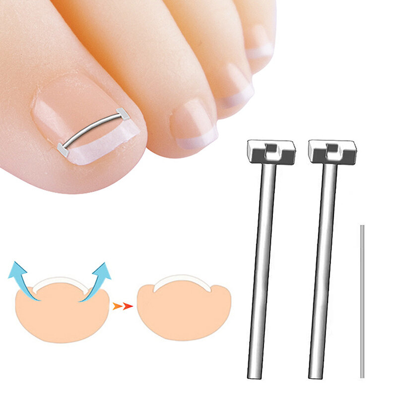 Ein gewachsene Zehen nagel korrektor Werkzeug Pediküre Erholung ein gewachsene Zehen nagel Behandlung profession elle ein gewachsene Zehen nagel Glättung sclip Werkzeug