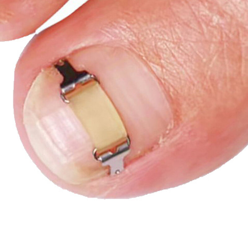 Narzędzia do korektora paznokci z wrastającym paznokieć Pedicure profesjonalna korekta paznokci wrastających w narzędzie do pielęgnacji stóp odzyskania osadzenia paznokci u stóp