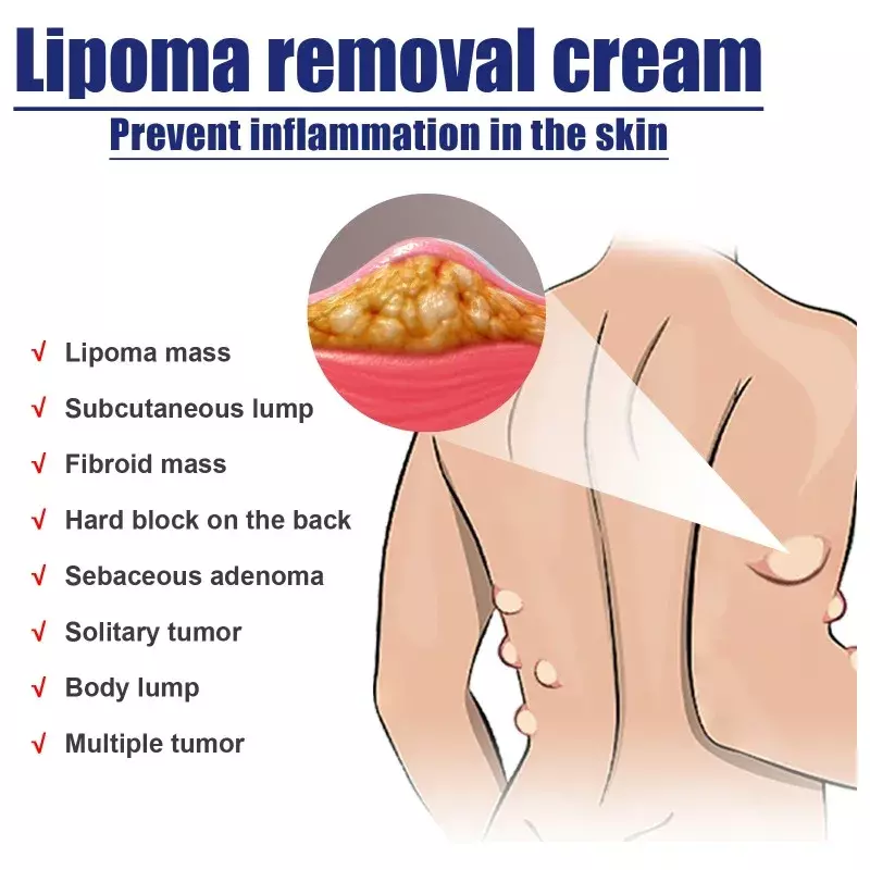 Lipom entfernung Salbe Cellulite Behandlung Fibrom entferner subkutane Klumpen mehrere Lipome Fett masse Medikamente Creme 20g