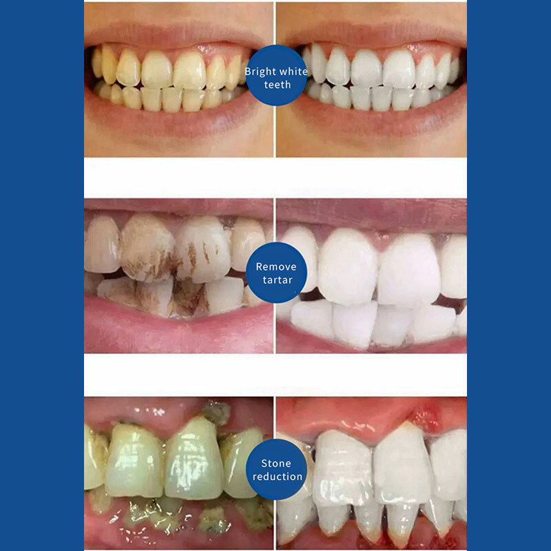 ใหม่ซ่อมฟันผุกำจัดคราบจุลินทรีย์ผุ Whitening สีเหลืองซ่อมฟันฟอกสีฟัน100G