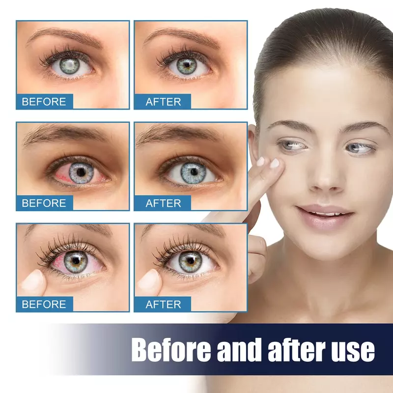 ยาหยอดตาสำหรับ glacoma presbyopia ตาสีแดงแห้งลดความเมื่อยล้าการมองเห็นที่ดีขึ้นไวท์เทนนิ่งเลนส์บำรุงดวงตา