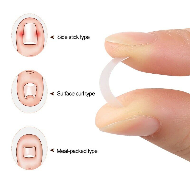 1 ~ 10 Stück 4-Nagel-Korrektur Aufkleber Paronychie ein gewachsene Zehen nagel Korrektur elastische Glättung Clip Klammer Pediküre