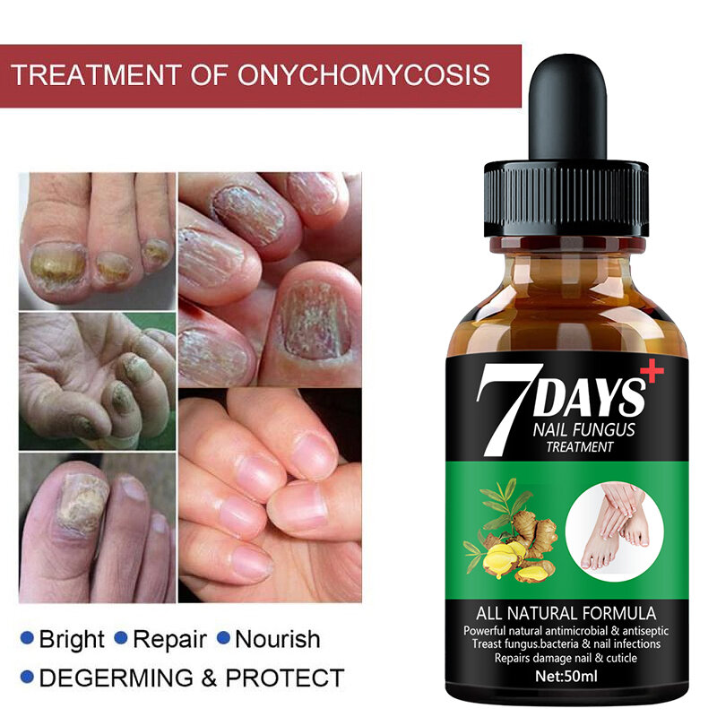 7 Tage Reparatur Nagel pilz Behandlungen Essenz Fußpflege Serum Zehen nägel Pilz entfernung Gel Anti-Infektion Onycho mykose (50ml)