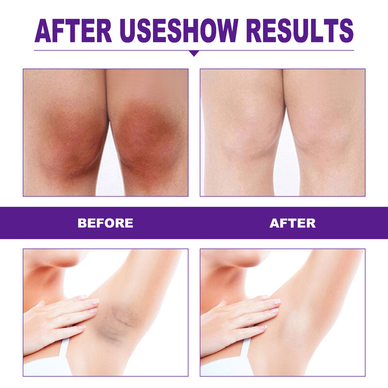 Whitening Cream Private Parts Whitening Cream Arm Thigh Body Knees Whitening Brighten Skin Mild Non-irritating