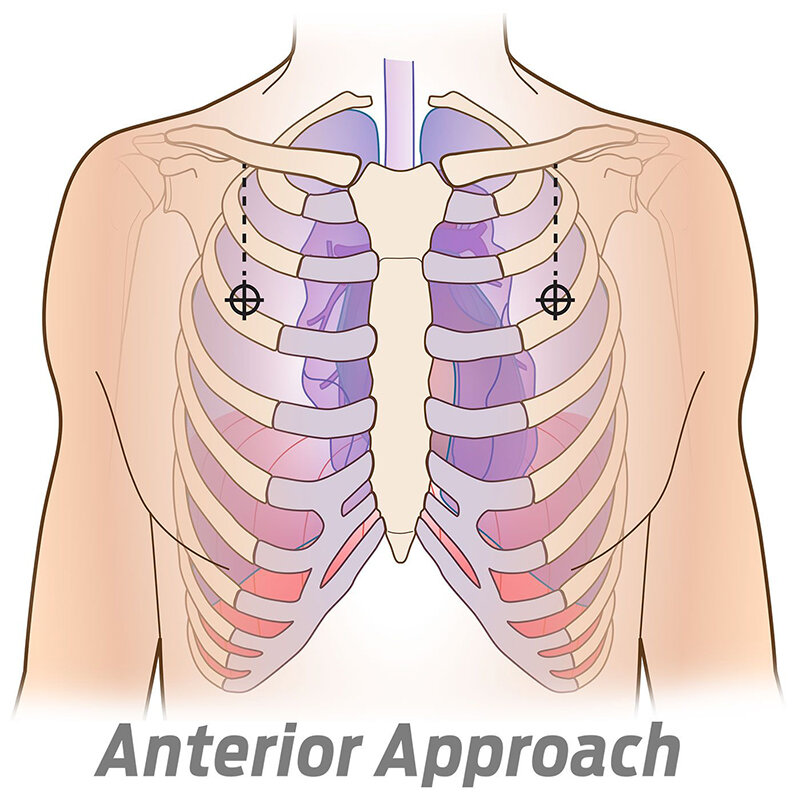 Einweg medizinische Brust Dekompression Nadel Spannung Pneumothorax Brustnadel Notfall ausrüstung Erste-Hilfe-Kit