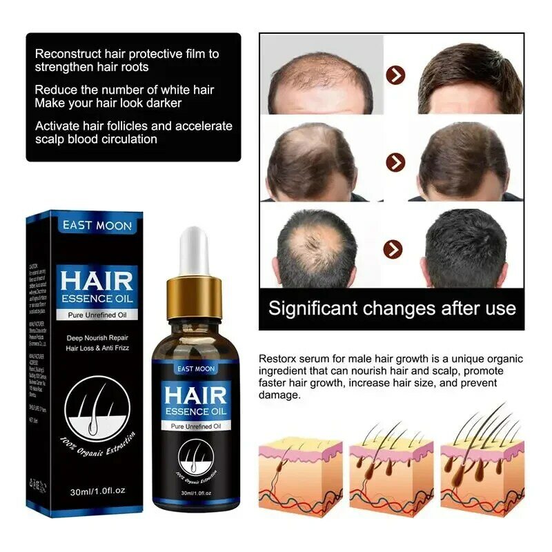 Fast Hair Growth Oil, Reparação Eficaz da Calvície, Herbal Hair Loss, Anti-Queda Pós-parto, Seborréica, 30ml