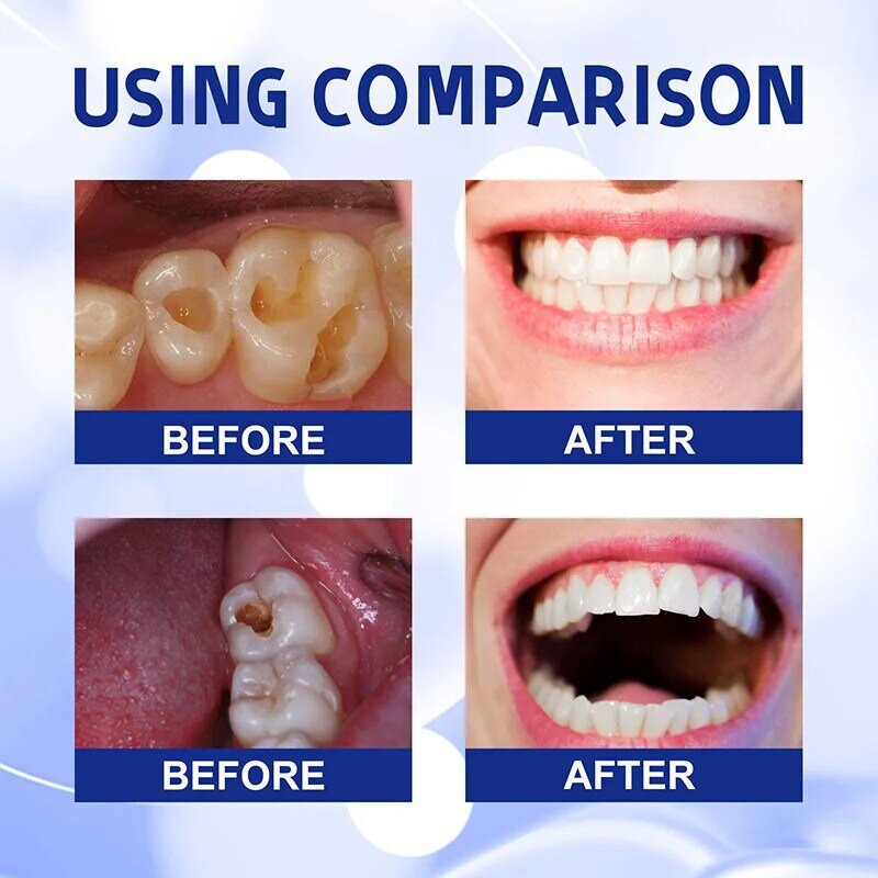 Sbiancamento dei denti riparazione carie alitosi fresca carie Anti-cavità rimuovere la placca mal di denti alleviare la parodontite