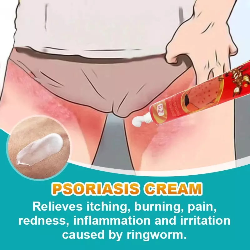 Psoriasis Herbal Antibacterial Cream Antipruritic Dermatitis Eczematoid Eczema Ointment Infections Anti-Inflammatory Skin Care