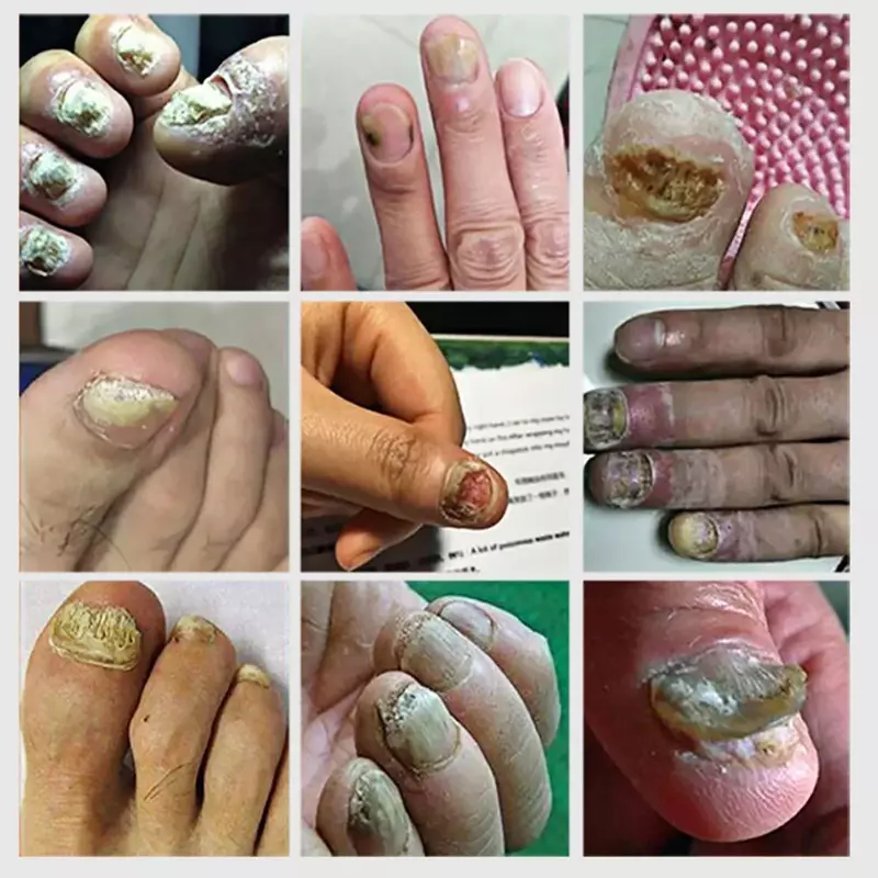 Tratamiento de uñas fungicida, aceite esencial, hongo de uñas, dispositivo láser, reparación de uñas de los pies, tratamiento de jengibre, líquido de esencia de mano y pie