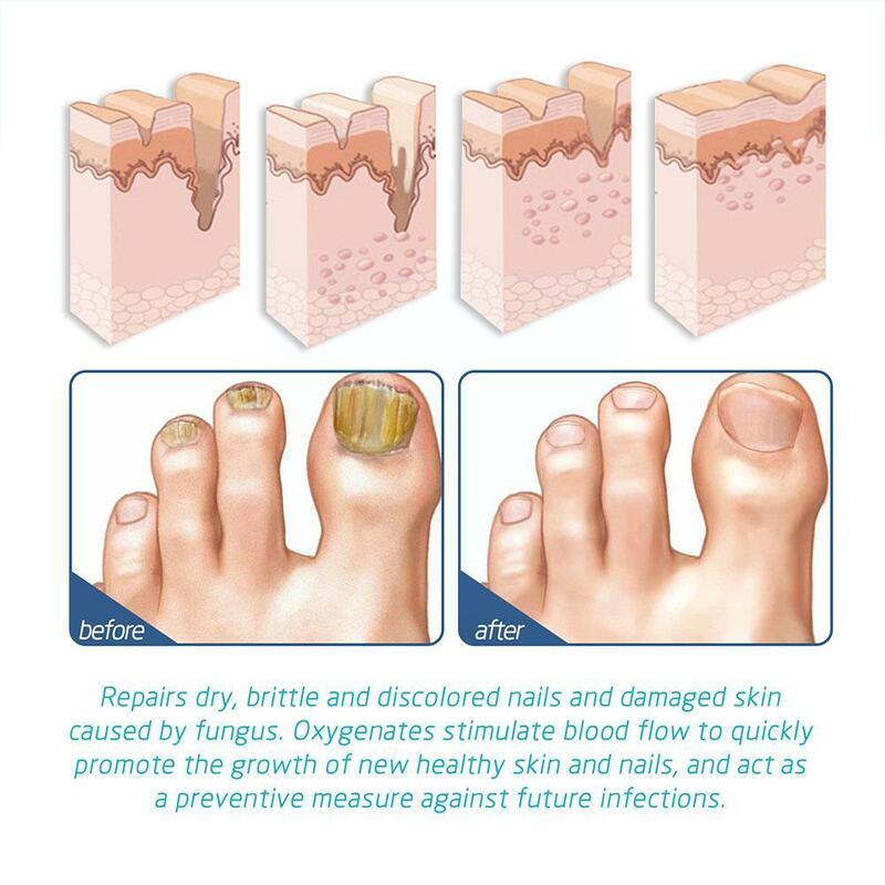 Semprotan penghilang bau kaki 30ml, semprotan penghilang bau kaki untuk melembabkan kulit kaki Anti retak menghilangkan bau perbaikan kuku segar U1Z3