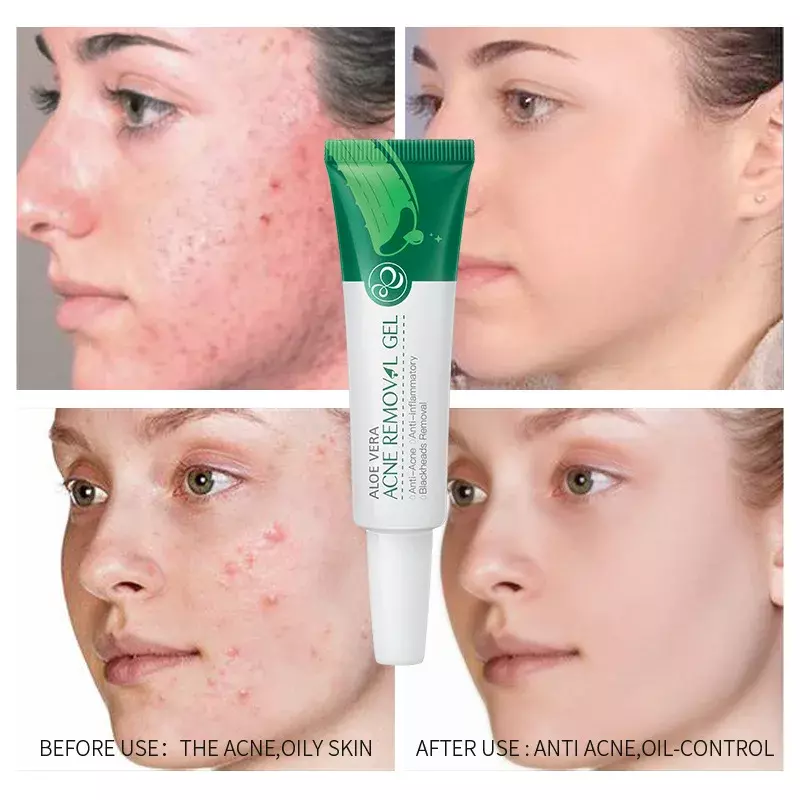 Aloe Vera Acne Removal Gel Acne Treatment Repair Moisturizing Remove Acne Print Control Oil Shrink Pores Whitening Skin Care 20g