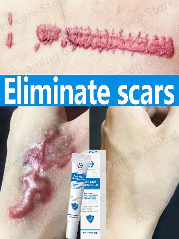 Scar Removal Cream for Old Scars Keloid Surgical Scar