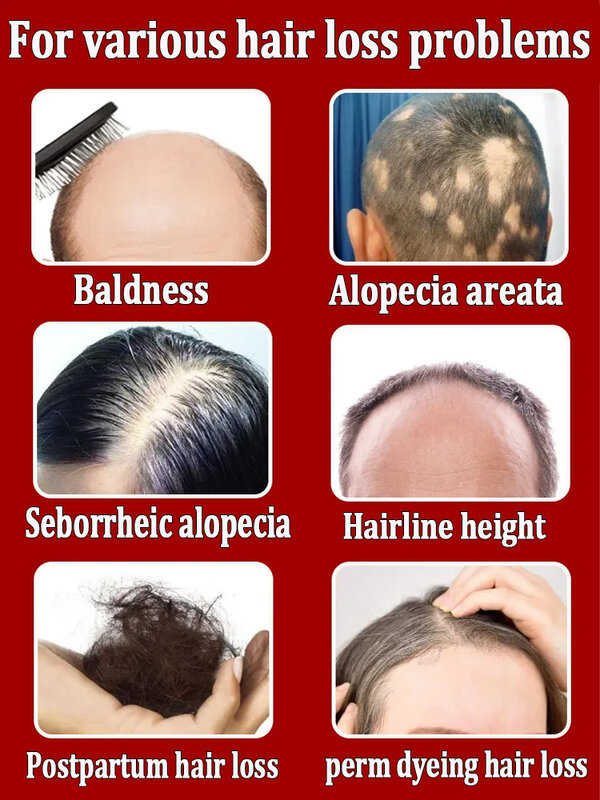 Óleo de crescimento capilar, reparação eficaz de calvície, queda de cabelo hereditária, queda de cabelo pós-parto