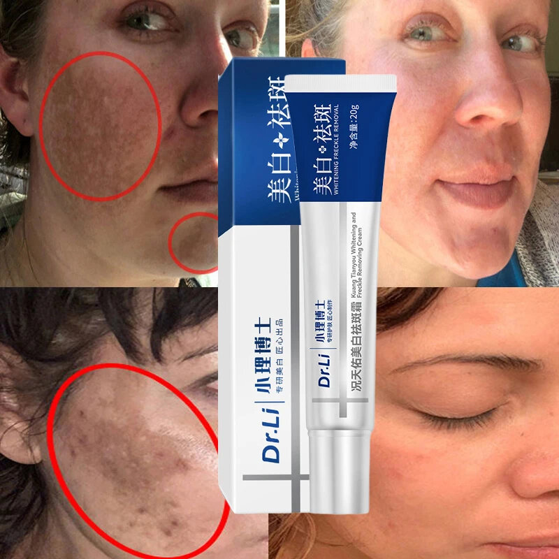 Whitening Freckles Cream Effective Remove Melasma Dark Spots Fade Pigmentation Moisturize Smooth Brighten Face Skin Care Product