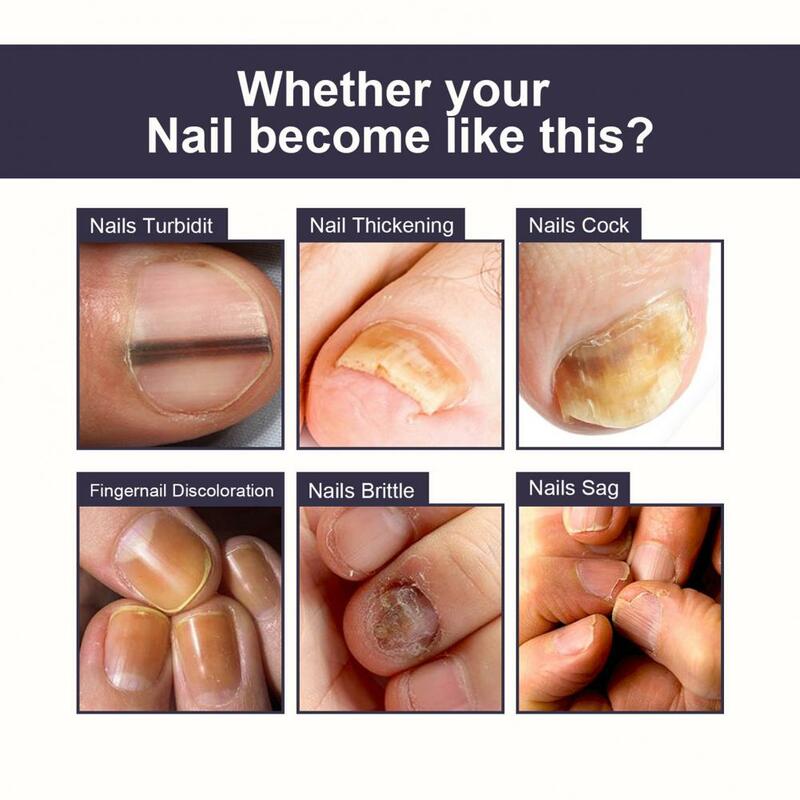 Siero universale per la riparazione delle unghie nutriente Unisex trattamento per unghie con cuticole screpolate a secco liquido non appiccicoso essenza per unghie cura dei piedi
