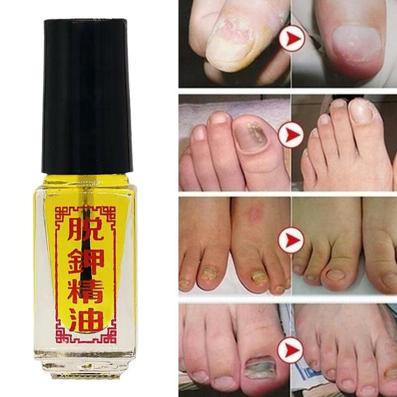 Tuojia 에센셜 오일, 손발톱진균증 제거 관리 곰팡이, 손톱 발가락 오일 감염 방지, 손톱 곰팡이, 1 개, 3 개, 5ml