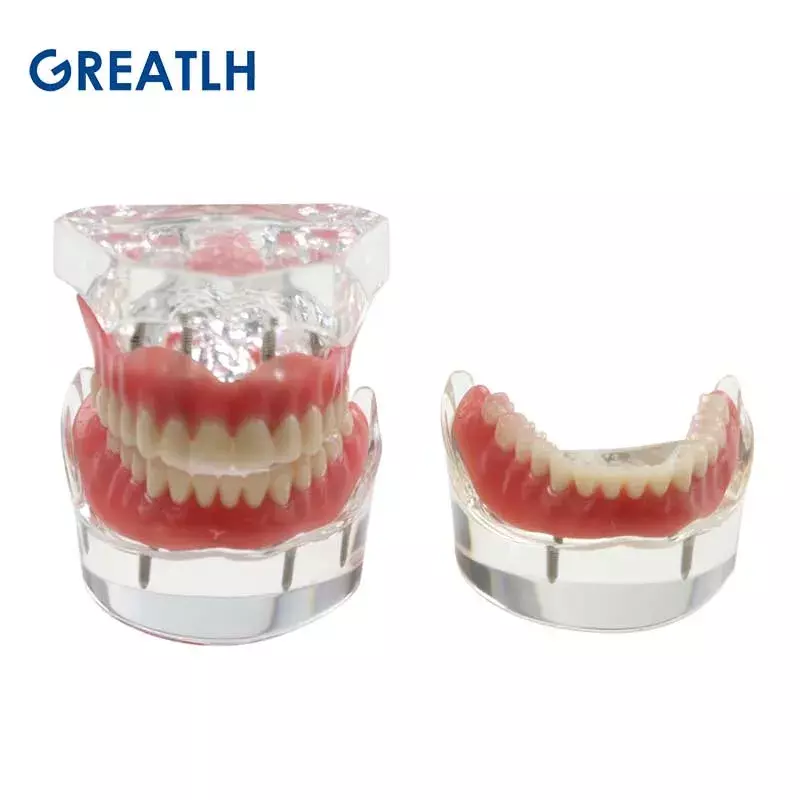 Modelo de dientes dentales con implante de sobredentadura Inferior, modelo de demostración Mandibular, modelo de aprendizaje para estudiantes de dentista