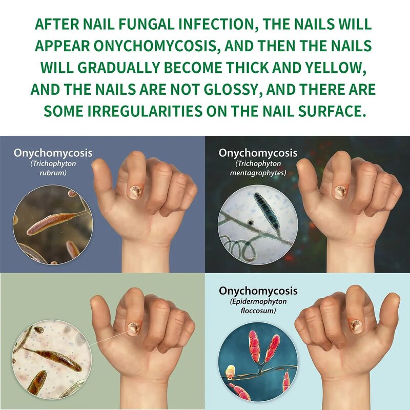 Fungal Nail Treatment Essence Oil Nail Fungus Laser Device Repair Toenail Fingernail Ginger Treatment Hand Foot Essence Liquid
