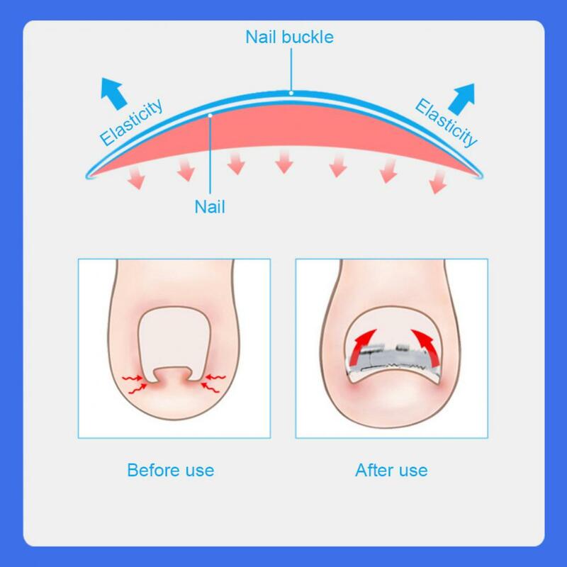 Strumenti per il correttore dell'unghia incarnita Pedicure recupera lo strumento per la cura dei piedi per la correzione dell'unghia incarnita