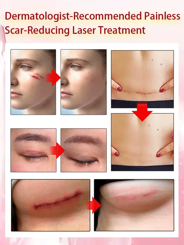 scar recover