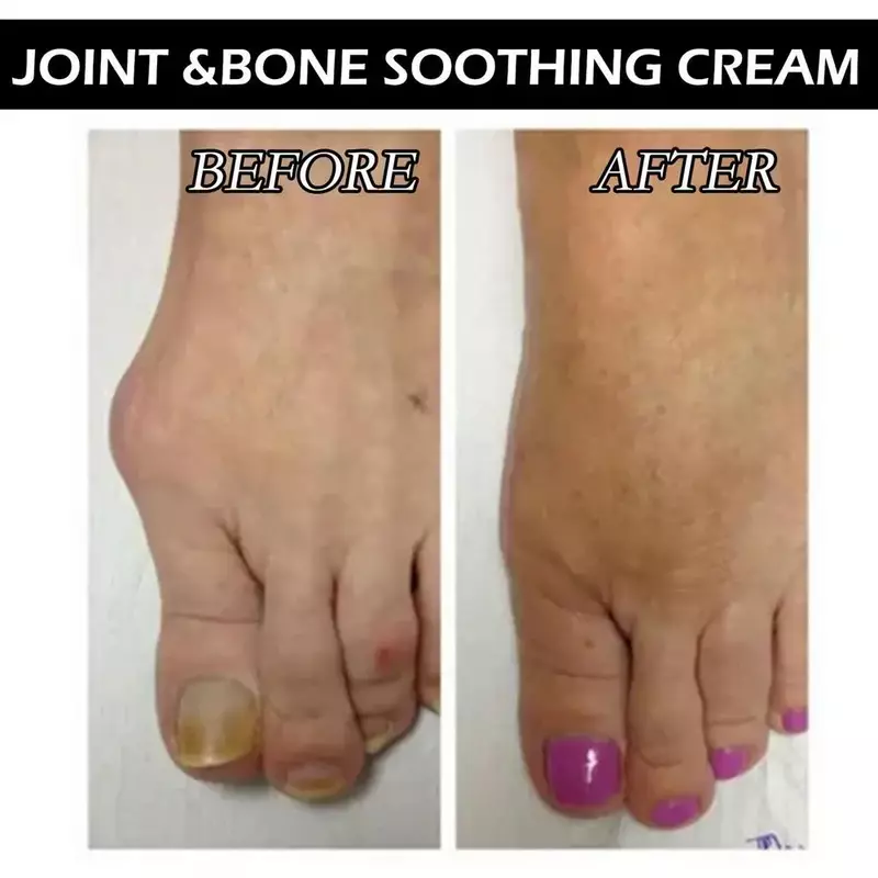 Joint Counterpain Cream, Corretor ortopédico Valgus, Pomadas de tratamento muscular do joelho, Creme de alívio do desconforto ósseo