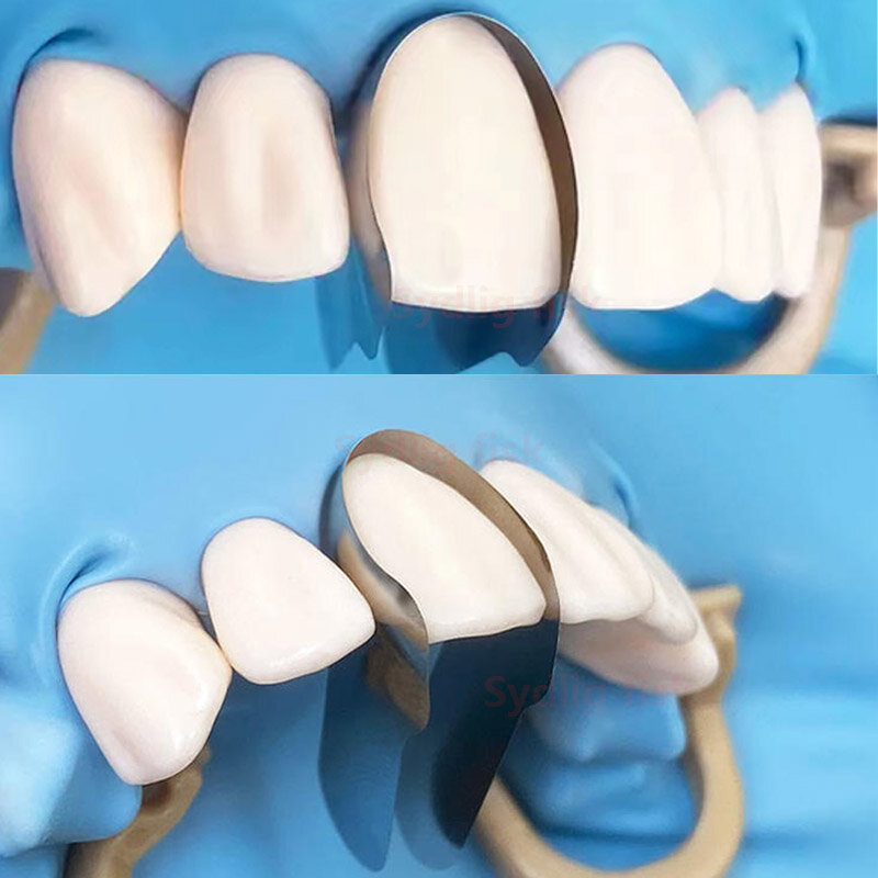 30 Stück Zahn matrix konturierte vordere Metall matrix bänder Schnitt matrix system Doppel anterioren matrizen Zahnmedizin ische Materialien