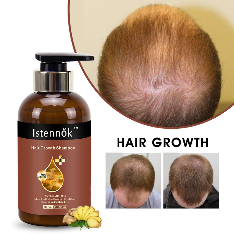 Cuidados de saúde beleza shampoo gengibre para produtos de crescimento rápido cabelo profissional anti-tratamento de perda de cabelo 328ml