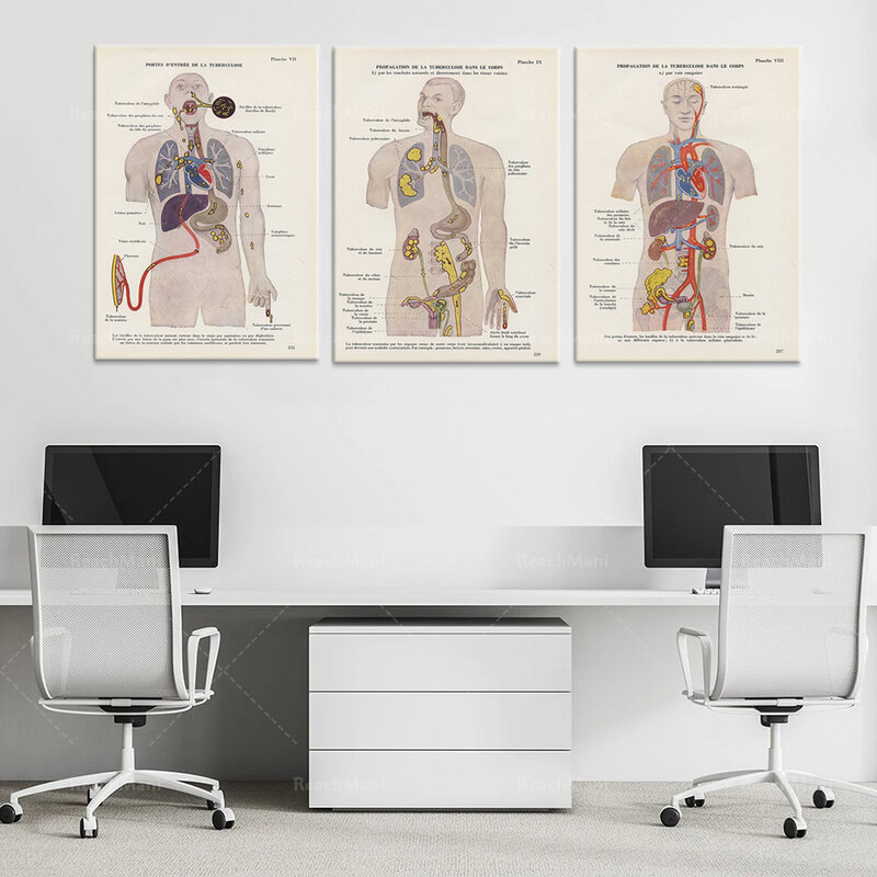 Grabado Médico de la TB desde 1952. Poster de anatomía decorativas médicas Vintage Decoración de la oficina del doctor, regalo de neumología