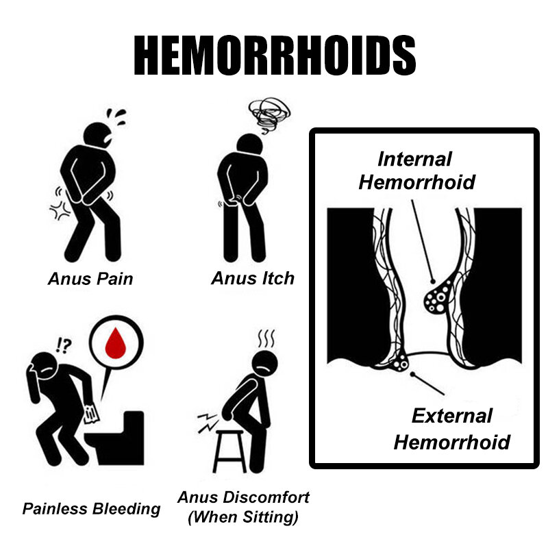 1Pcs Hemorrhoid Treatment ครีมภายในภายนอก Hemorrhoid Anal Fissure Bloody จีนปวด Relief ครีม G003