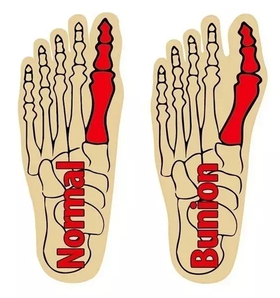 Dedos dos pés meias separador polegar ajustador straightener pés osso orthotics aparelho hallux valgus splint manga bunion corrector