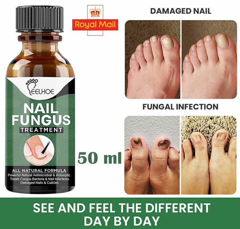 50ml Nail Fungus Remover Mycoses Remedy Foot And Hand Cream For Nail Repair Athlete'S Foot Cure Gray Nail Solution