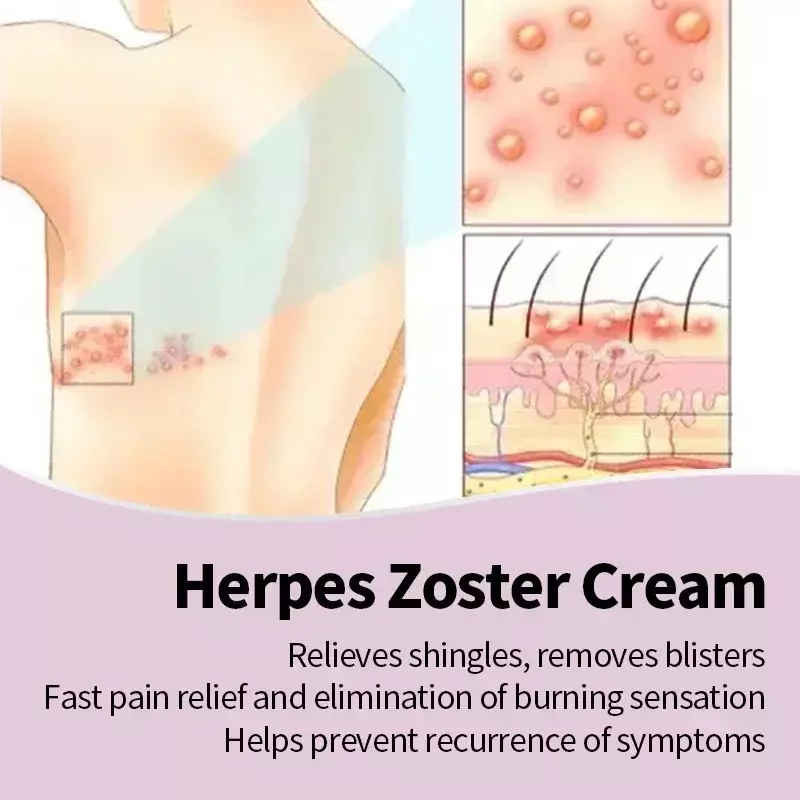 Herpes Zoster Behandeling Crème Gordelroos Genezen Huid Medicijn Slang Pijnlijke Rode Stip Blaar Herpes Simplex Thailand Zalf 50G