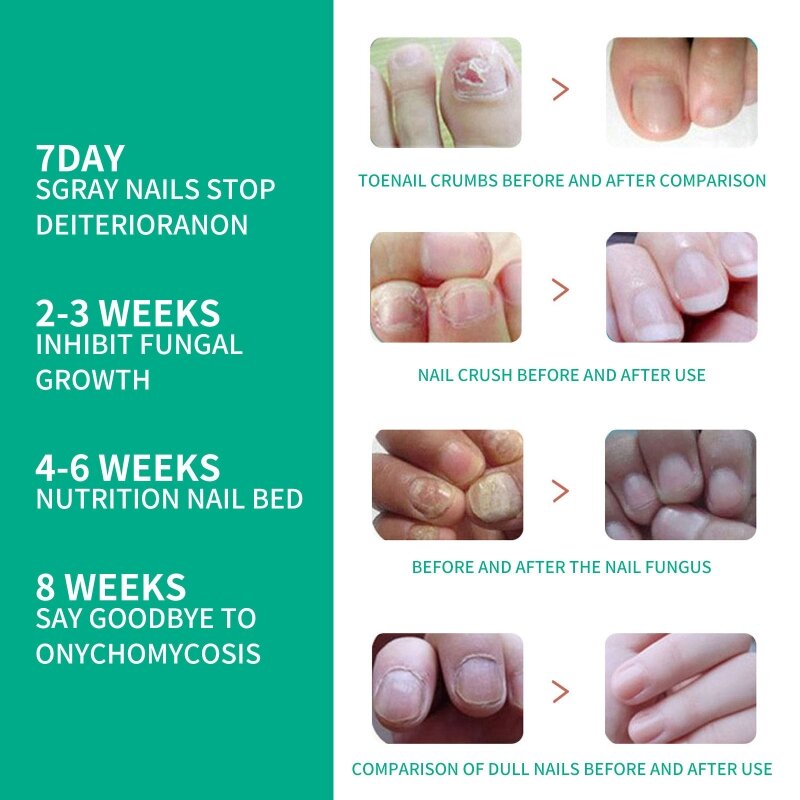 Solution traitement des champignons des ongles des pieds des orteils, répare renouvelle les dommages causés aux ongles