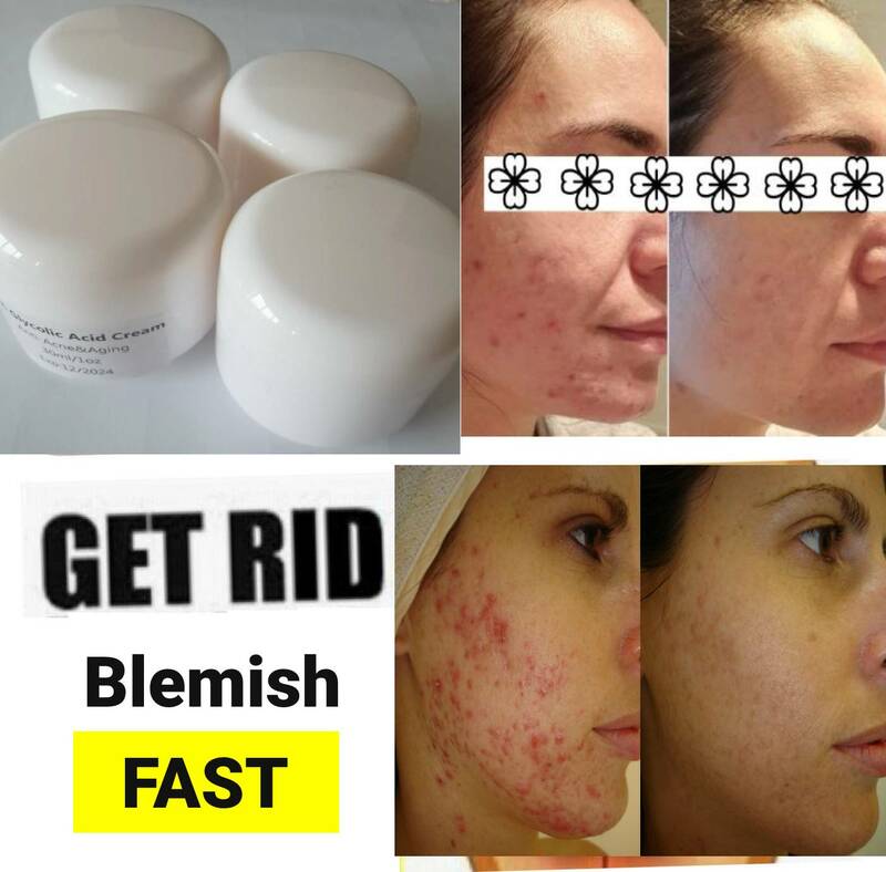 Crema de ácido glicólico al 50%, tratamiento antienvejecimiento de grado médico, reduce la aparición de arrugas, crema para la piel desigual, reafirmante