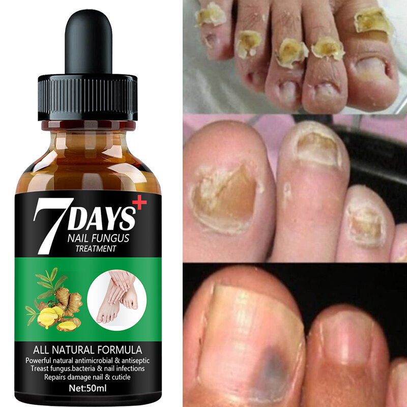 Эссенция для восстановления и лечения грибка ногтей на 7 дней, сыворотка для ухода за ногами, гель для удаления грибка на ногтях, антиинфекционный онихомикоз (50 мл)