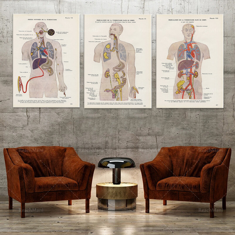 Grabado Médico de la TB desde 1952. Poster de anatomía decorativas médicas Vintage Decoración de la oficina del doctor, regalo de neumología