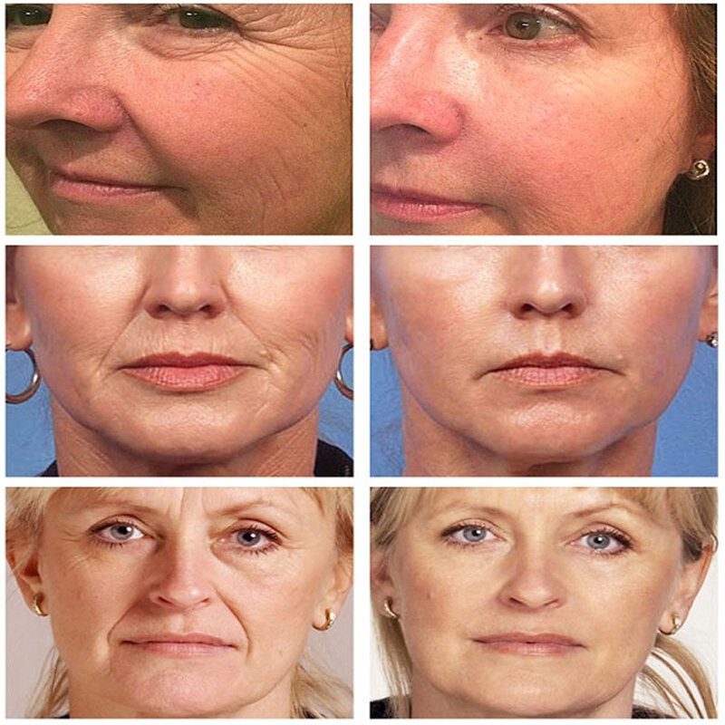 V1.Peptide-Sérum raffermissant anti-âge pour le visage, élimine le déformable, estompe les ridules, essence pour le traitement des lignes du visage, voiture frontale