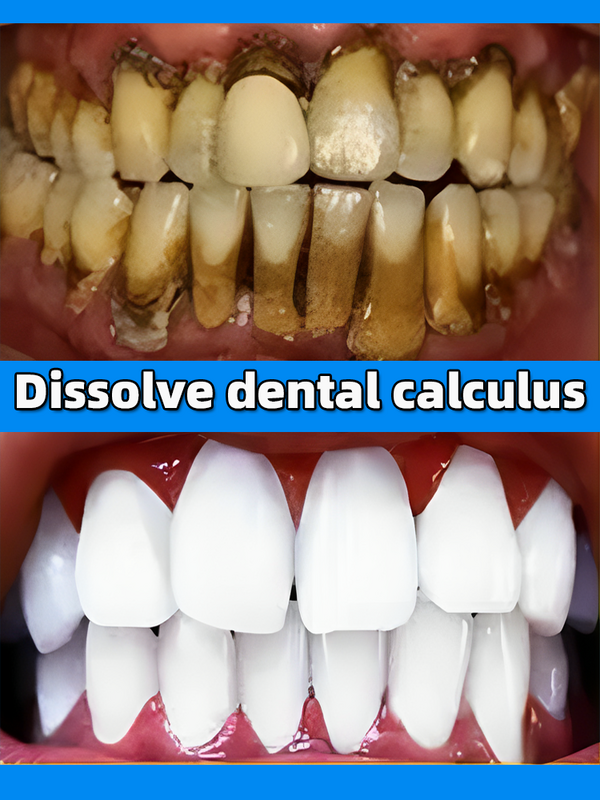 Dentífrico removedor de cálculo dental, clareamento, boca remoção do odor, mau hálito, prevenção da periodontite, limpeza dental, novo