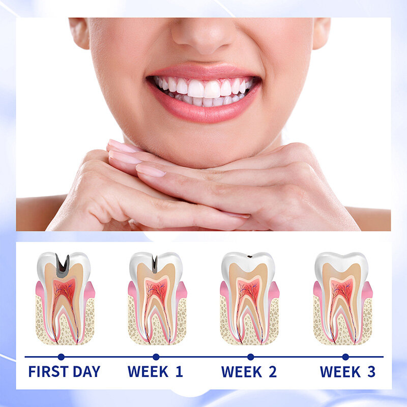 Anti-Decay Creme Dental, Creme Reparação de Cárie Dentária, Prevenir a Decadência Dental, Proteger a Placa Dental, Aliviar Dor de Dente, Periodontite