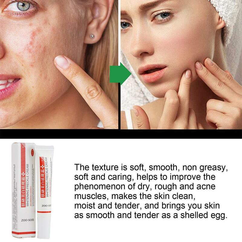 1~5X Effective Whitening Freckle Cream Remove Dark Spots Anti Freckle Cream Fade Pigmentation Melasma Brighten Creams Skin Care