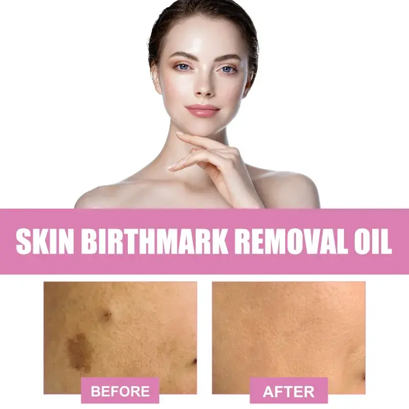 Skin Birthmark removal Serum Anti Freckle fade Pigmentation Melasma Moisturizing Whitening Brighten Face  Care Essence Oil