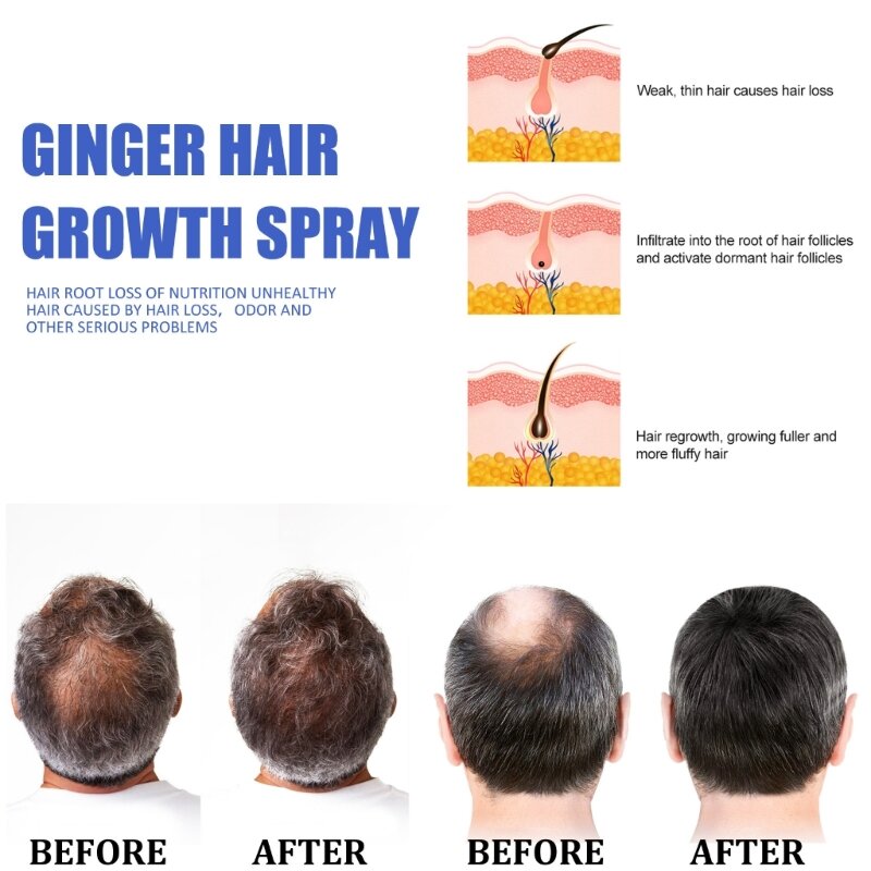 Gengibre cabelo grosso anti queda cabelo tratamentos perda cabelo essência crescimento do cabelo e0bd