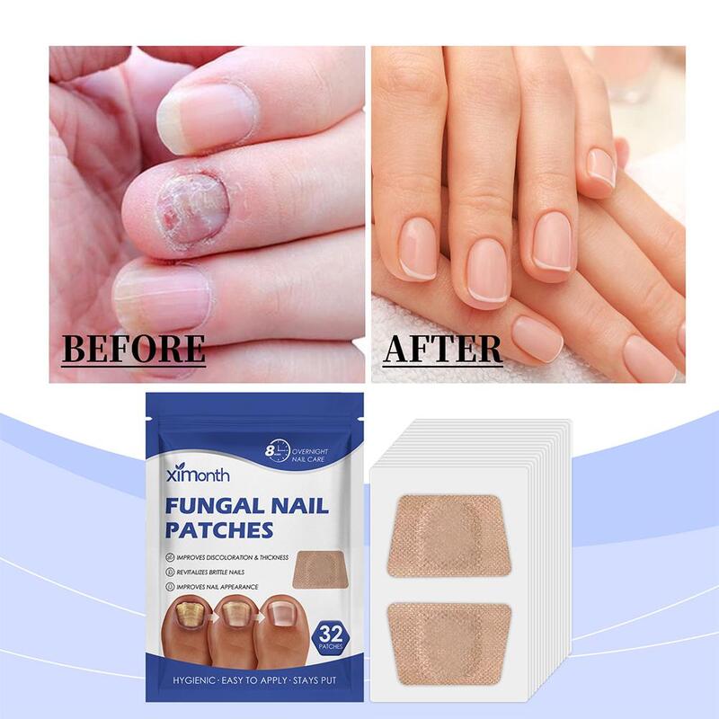 32 Patch/confezione di toppe per funghi dell'unghia del piede toppe appiccicose per la riparazione delle unghie adesivi per la correzione incarnita delle unghie per unghie scolorite o danneggiate