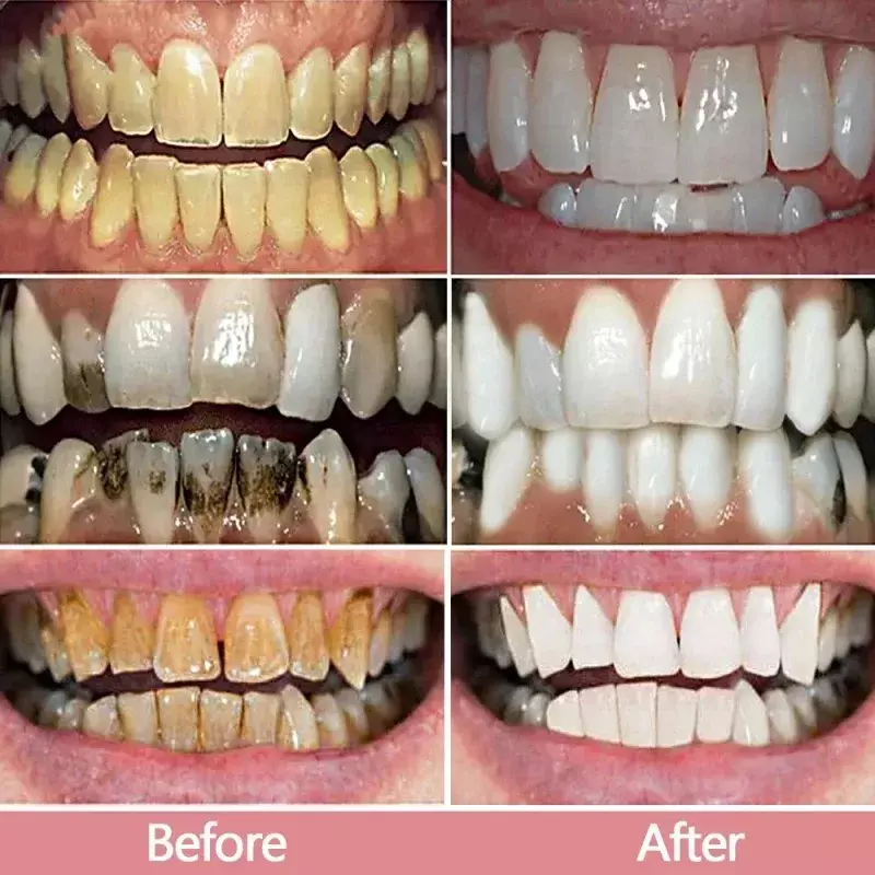 Pasta gigi ungu korektor warna pemutih gigi, perawatan gigi profesional menghilangkan noda segar